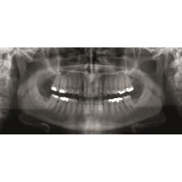 GENDEX GXDP-300 - цифровая панорамная рентгенодиагностическая система