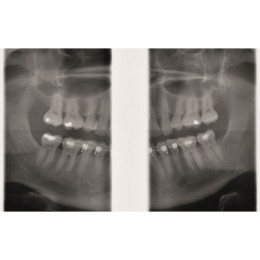 GENDEX GXDP-300 - цифровая панорамная рентгенодиагностическая система