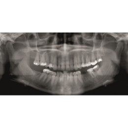 GENDEX GXDP-300 - цифровая панорамная рентгенодиагностическая система