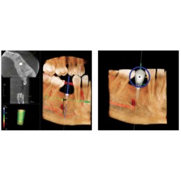 GENDEX GXDP-700 - цифровая панорамная рентгенодиагностическая система с возможностью дооснащения модулем цефалостата и функцией 3D-томографии