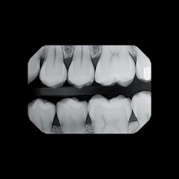 Gendex GXS-700 - система компьютерной радиовизиографии (сенсор №1)