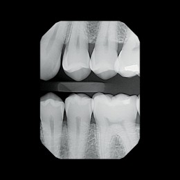 Gendex GXS-700 - система компьютерной радиовизиографии (сенсор №1)