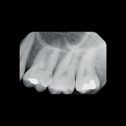 Gendex GXS-700 - система компьютерной радиовизиографии (сенсор №1)