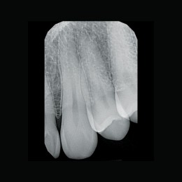 Gendex GXS-700 - система компьютерной радиовизиографии (сенсор №1)