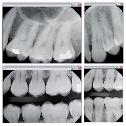 Gendex GXS-700 - система компьютерной радиовизиографии (сенсор №1)