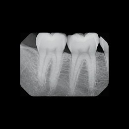 Gendex GXS-700 - система компьютерной радиовизиографии (сенсор №1)