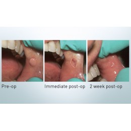 FONALaser - стоматологический диодный лазер