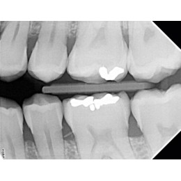 X-Mind DC Mobile - высокочастотный мобильный дентальный рентгеновский аппарат