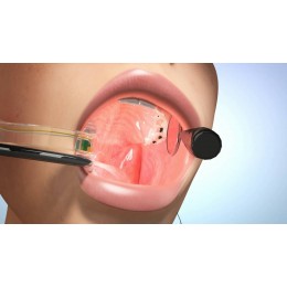 eBite (Electronic Bite) - беспроводная система интраоральной подсветки и аспирации