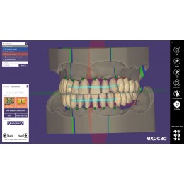 Exocad Full Denture Module - модуль для создания полносъемных протезов