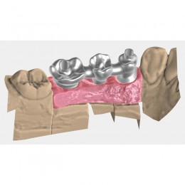 Exocad Implant Module - модуль для создания имплантов