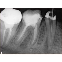 PORT-X II - портативный высокочастотный интраоральный рентгеновский аппарат
