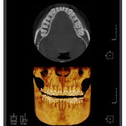 RAYSCAN Symphony Alpha OCL – ортопантомограф c цефалостатом (One Shot), 33х33 см