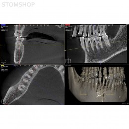 I-Max Touch 3D - цифровой панорамный рентгеновский аппарат