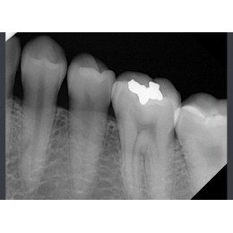 RIOSensor RIS500 - цифровой радиовизиограф 