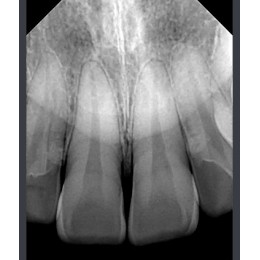 RIOSensor RIS500 - цифровой радиовизиограф 