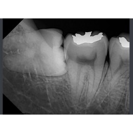RIOSensor RIS500 - цифровой радиовизиограф 