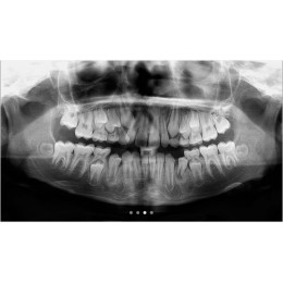 Cranex Novus e NEW - цифровой ортопантомограф с максимальным анодным напряжением 70кВ
