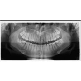 Cranex Novus e NEW - цифровой ортопантомограф с максимальным анодным напряжением 70кВ