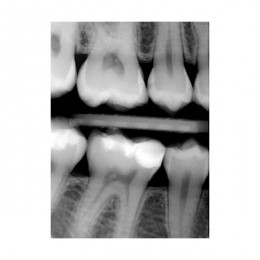 SuniRay2 - система компьютерной радиовизиографии
