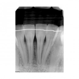 SuniRay2 - система компьютерной радиовизиографии
