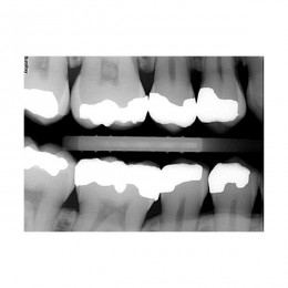 SuniRay2 - система компьютерной радиовизиографии