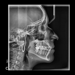 Pax-i SC - цифровой панорамный аппарат с цефалостатом непрерывного сканирования