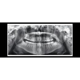 Planmeca ProOne - универсальный цифровой ортопантомограф