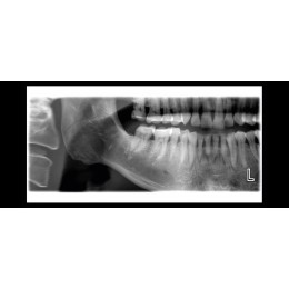 Planmeca ProOne - универсальный цифровой ортопантомограф