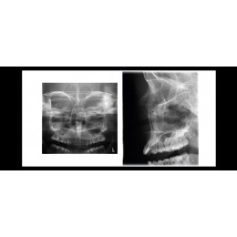 Planmeca ProOne - универсальный цифровой ортопантомограф